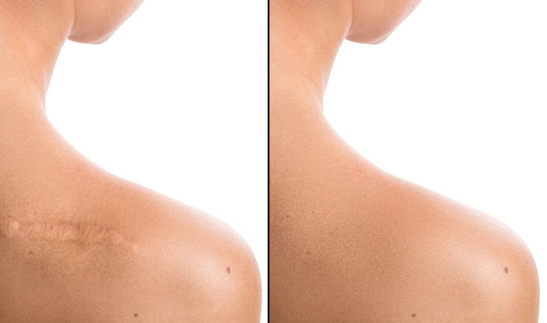 Comparison of female shoulder after scar removing procedure