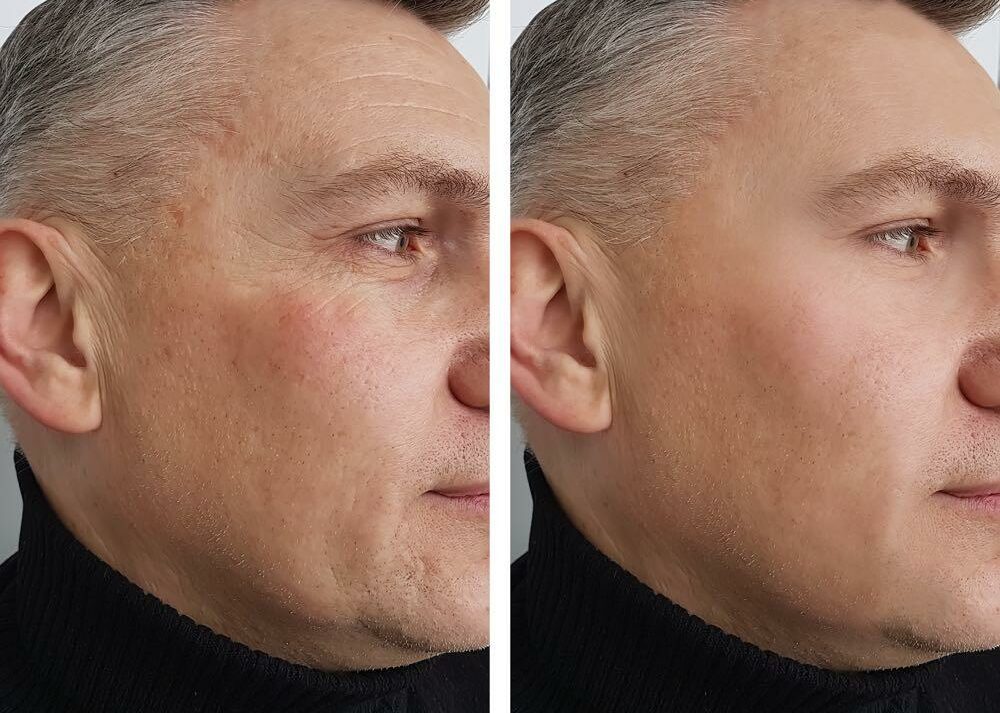 injectable-before-after