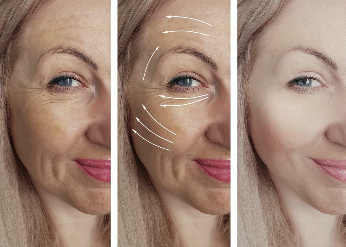 woman wrinkles face before and after treatment