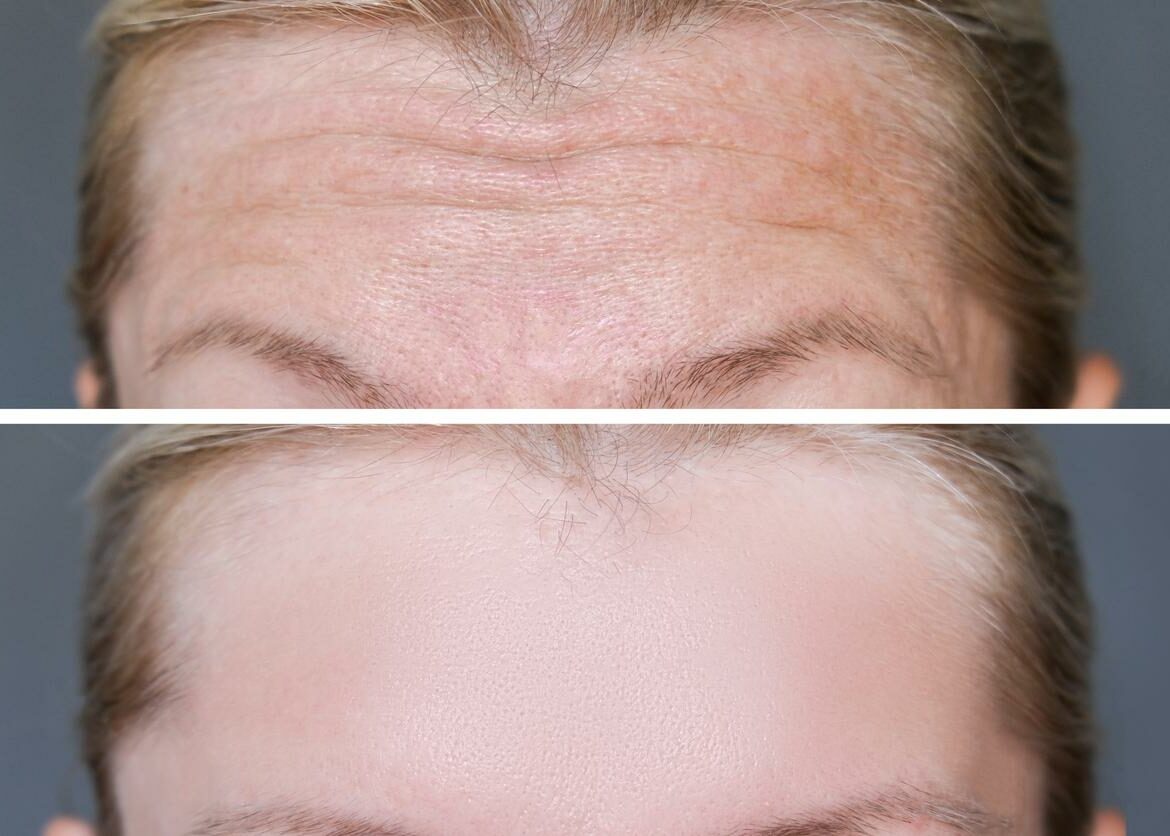 Deep mimic forehead wrinkles before and after treatment, smoothing and correction of face wrinkles as a result of rejuvenation or injection botulinum toxin.