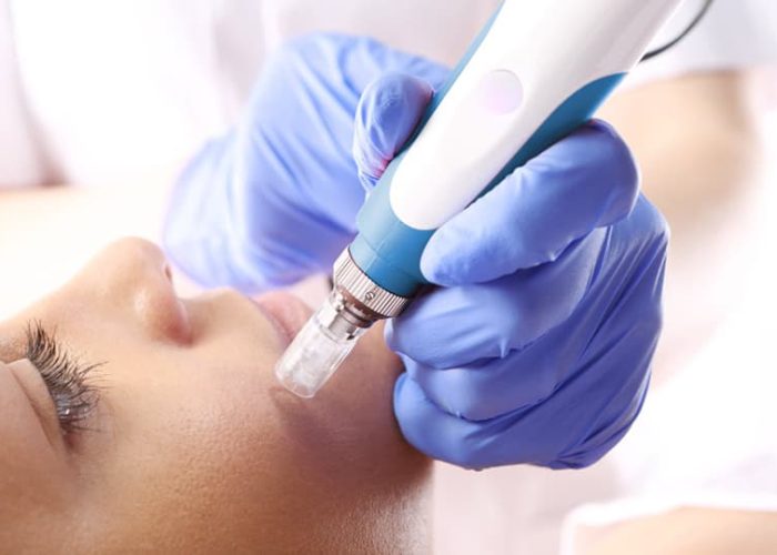 MICRO-NEEDLING-Spa-Click-thru-pics