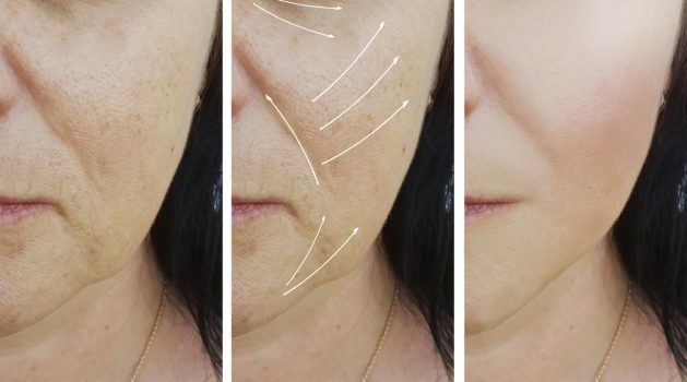 woman facial wrinkles correction before and after procedures arrow