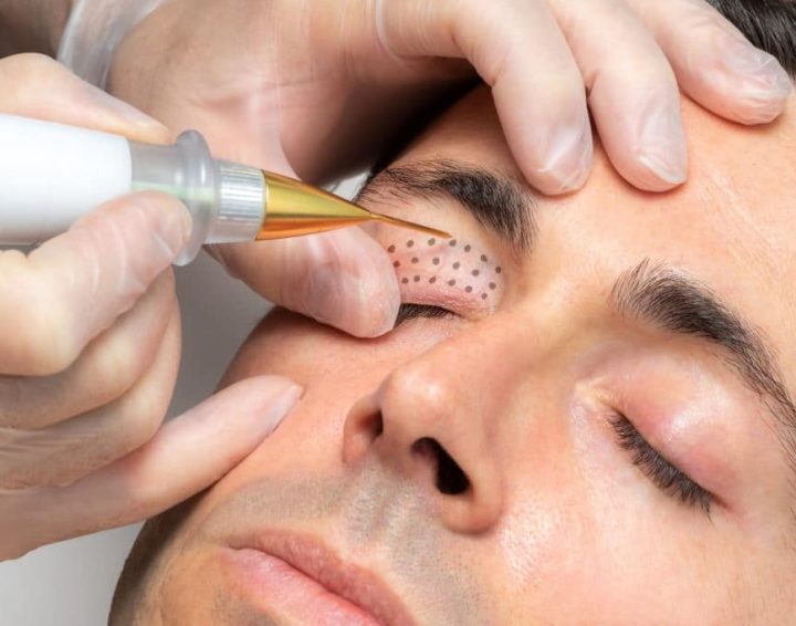 plasma-pen-fibroblast-therapy.jpg